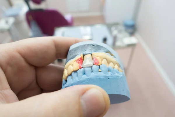 Korony Ceramiki Dentystycznej Modelu Gipsu Rękach Lekarzy — Zdjęcie stockowe