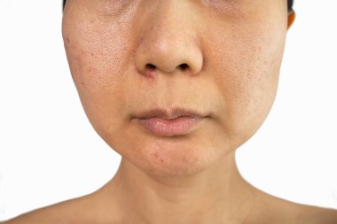 Yüzünde sivilce iltihabı (Papule ve Pustule) olan yarım yüzlü bir kadın. Kadın teninde kavramsal sorunlar. Büyütülmüş gözenekli cilt.