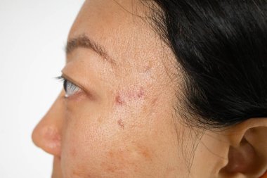 Yüzünde sivilce iltihabı (Papule ve Pustule) olan endişeli Asyalı kadının portresi. Kadın tenindeki sorunların kavramı.