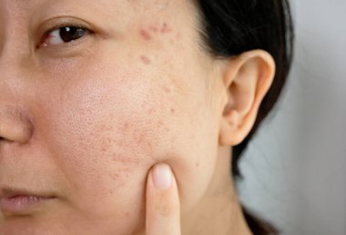 Portrait of worrying asian woman with problems of acne inflammation (Papule and Pustule) on her face. Conceptual of problems on woman skin. clipart