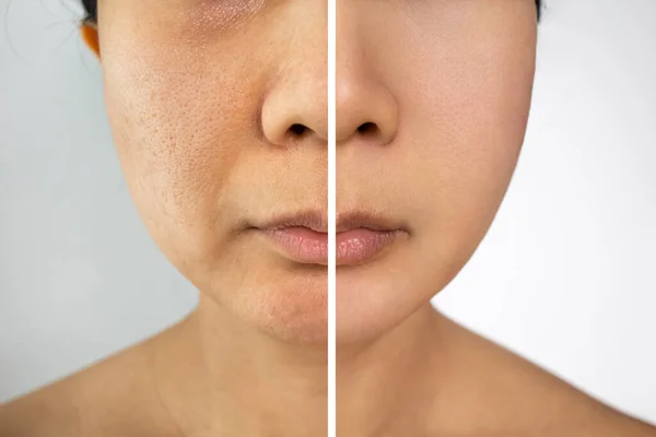 Σύγκριση Πορτρέτο Μιας Γυναίκας Προβληματικό Δέρμα Χωρίς Και Μακιγιάζ — Φωτογραφία Αρχείου