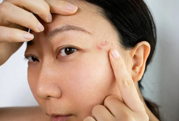 Porträt Einer Beunruhigenden Asiatischen Frau Mit Akne Entzündungen Papeln Und — Stockfoto