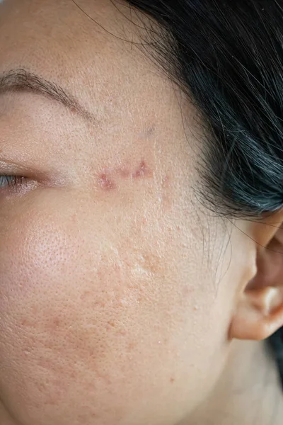 Ritratto Preoccupante Donna Asiatica Con Problemi Infiammazione Dell Acne Papule — Foto Stock
