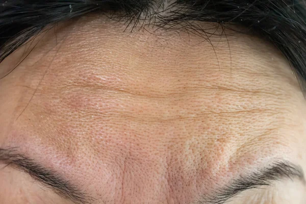 Cara Mujer Cerca Con Arrugas Frente Concepto Colágeno Inyecciones Faciales — Foto de Stock