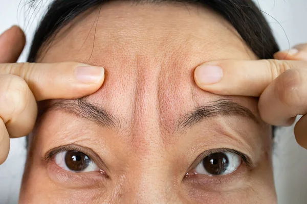 Cara Mujer Cerca Con Arrugas Frente Concepto Colágeno Inyecciones Faciales — Foto de Stock