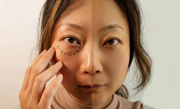 Asian Woman Eye Bag Puffy Eye Girl Showing Eyes Bags — Stockfoto