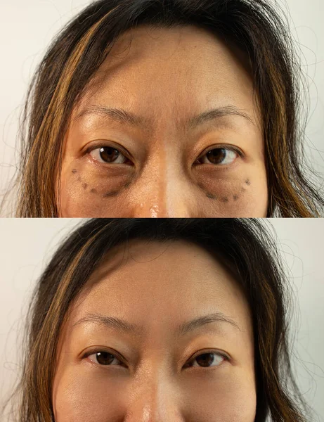 Asian Woman Eye Bag Puffy Eye Girl Showing Eyes Bags — Stockfoto