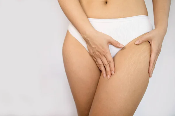 Close Female Legs Stretch Marks Pink Background — Φωτογραφία Αρχείου