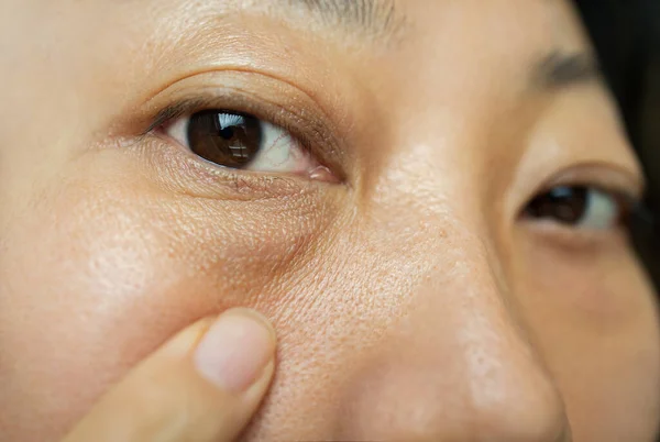 Mujer Asiática Tienen Arrugas Faciales Bolsas Grandes Bajo Sus Ojos — Foto de Stock