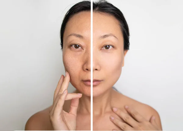 Cilt Gençleştirme Konsepti. Beyaz arka plandaki kozmetik operasyonundan önce ve sonra. Asyalı kadınlar için beyazlatıcı krem.