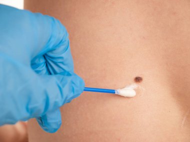 doctor examines the growths on the skin of an adult with a magnifying glass, diagnosis of skin cancer. Dermatologist examines the moles of the patient on a light background