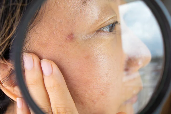 Facial Skin Problem Young Asian Woman Acne Magnifying Glass Check — Foto de Stock