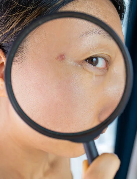 Facial Skin Problem Young Asian Woman Acne Magnifying Glass Check — Foto de Stock