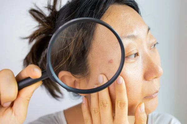 Facial Skin Problem Young Asian Woman Acne Magnifying Glass Check — Stok Foto