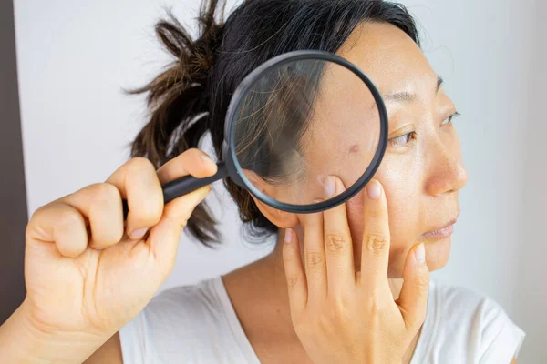 Facial Skin Problem Young Asian Woman Acne Magnifying Glass Check — Stok Foto