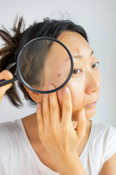 Facial Skin Problem Young Asian Woman Acne Magnifying Glass Check — Stok Foto