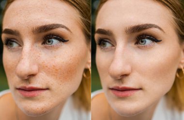 Woman face before and after cosmetic procedure for cleaning the face. concept of treatment and removal of freckles.