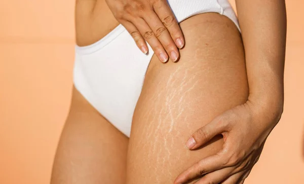 Stretch marks on female legs. A woman's hand holds a fat cellulite and a stretch mark on her leg. Cellulite close-up.