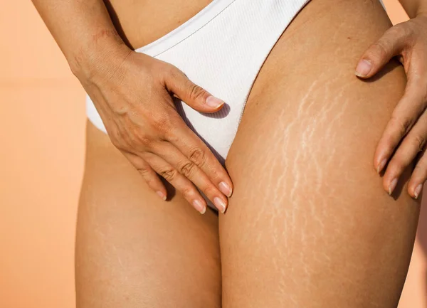 Stretch marks on female legs. A woman\'s hand holds a fat cellulite and a stretch mark on her leg. Cellulite close-up.