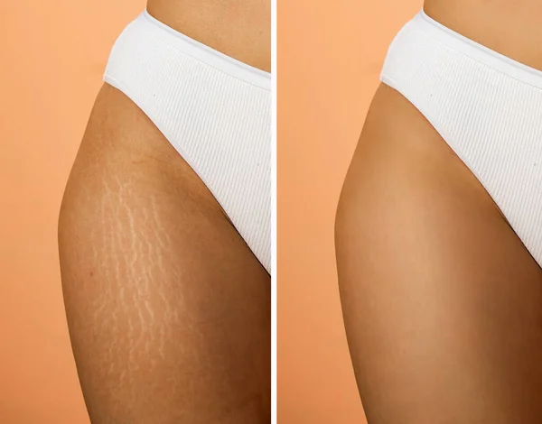 Image Compare Woman Legs Stretch Marks Removal Treatment Real People — 图库照片