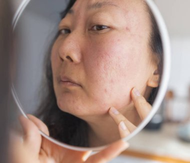 Dermatoloji, ergenlik çağındaki Asyalı genç bir kadın, aynaya bakan bir kız, alerji, kozmetik, kırmızı nokta ya da yüzündeki kızarıklık yüzünden alerjik reaksiyon gösteriyor. Tıbbi tedaviden kaynaklanan cilt bakımı.