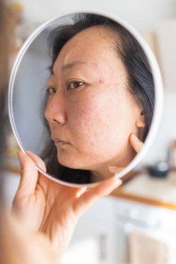 Dermatoloji, ergenlik çağındaki Asyalı genç bir kadın, aynaya bakan bir kız, alerji, kozmetik, kırmızı nokta ya da yüzündeki kızarıklık yüzünden alerjik reaksiyon gösteriyor. Tıbbi tedaviden kaynaklanan cilt bakımı.