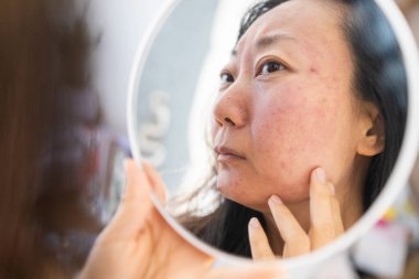 Dermatoloji, ergenlik çağındaki Asyalı genç bir kadın, aynaya bakan bir kız, alerji, kozmetik, kırmızı nokta ya da yüzündeki kızarıklık yüzünden alerjik reaksiyon gösteriyor. Tıbbi tedaviden kaynaklanan cilt bakımı.