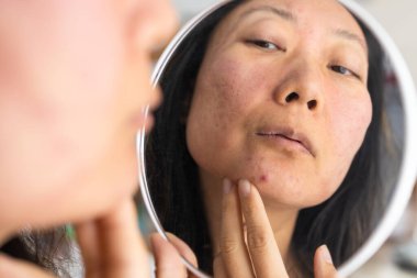 Dermatoloji, ergenlik çağındaki Asyalı genç bir kadın, aynaya bakan bir kız, alerji, kozmetik, kırmızı nokta ya da yüzündeki kızarıklık yüzünden alerjik reaksiyon gösteriyor. Tıbbi tedaviden kaynaklanan cilt bakımı.
