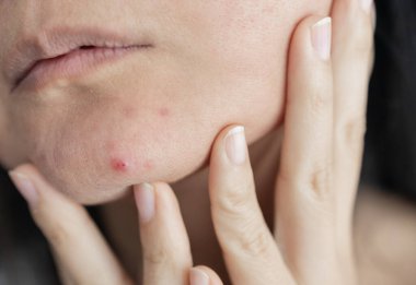 Dermatoloji, ergenlik çağındaki Asyalı genç bir kadın, aynaya bakan bir kız, alerji, kozmetik, kırmızı nokta ya da yüzündeki kızarıklık yüzünden alerjik reaksiyon gösteriyor. Tıbbi tedaviden kaynaklanan cilt bakımı.