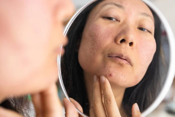 Dermatologi Wanita Muda Asia Pubertas Gadis Yang Melihat Cermin Alergi — Stok Foto