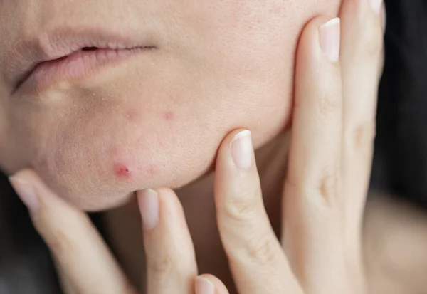 Dermatologi Wanita Muda Asia Pubertas Gadis Yang Melihat Cermin Alergi — Stok Foto