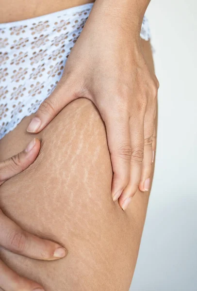 Stretch marks on female legs. A woman\'s hand holds a fat cellulite and a stretch mark on her leg. Cellulite.