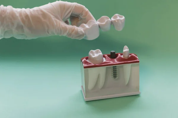 Dentist In Gloves Showing Dental Tooth Bridge Model