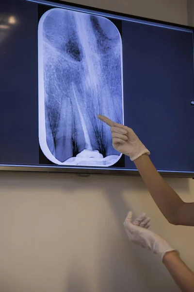 Doctor points to filled root canal in dental x-ray