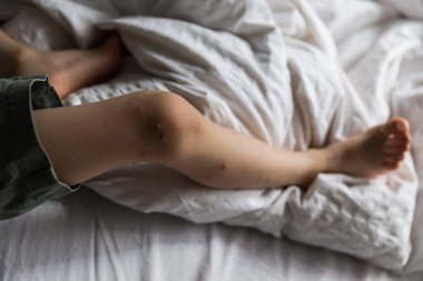 Bebek elinde oyuncak, suçiçeği olan çocuk, yatakta yatıyor.