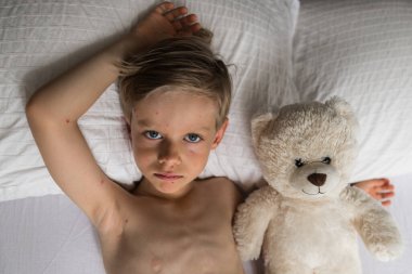 Bebek elinde oyuncak, suçiçeği olan çocuk, yatakta yatıyor.