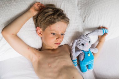 Bebek elinde oyuncak, suçiçeği olan çocuk, yatakta yatıyor.