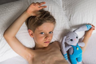 Bebek elinde oyuncak, suçiçeği olan çocuk, yatakta yatıyor.