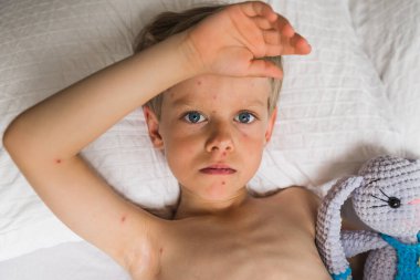 Varisella virüsü taşıyan küçük bir çocuk yatakta yatar ve... 