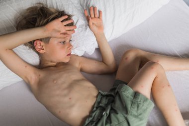 Varisella virüsü olan küçük bir çocuk yatakta yatıyor. Varicella zoster.