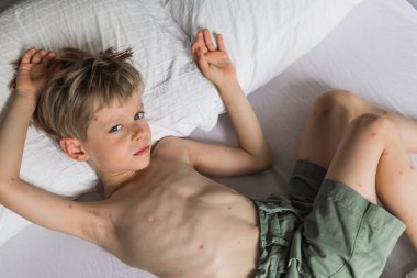 Varisella virüsü olan küçük bir çocuk yatakta yatıyor. Varicella zoster.