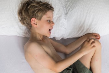 Kaşınan küçük çocuğun suçiçeği portresi.