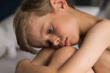 Varisella virüsü taşıyan küçük bir çocuk yatakta yatar ve... 