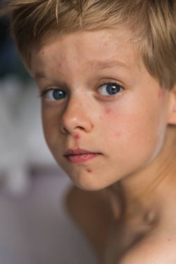 Varisella virüsü taşıyan küçük bir çocuk yatakta yatar ve... 