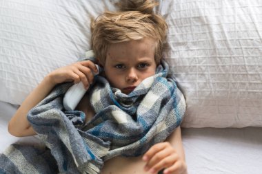 Suçiçeği olan çocuk yatakta yatıyor ve vücut ısısını ölçüyor..