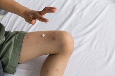 Suçiçeği bulaşmış çocuk derisi tedavi görüyor.