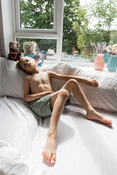 Хлопчик Тоддлер Віспою Лежить Ліжку Гарячкою — стокове фото