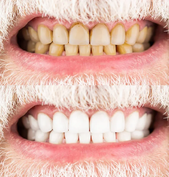 Męskie zęby przed i po wybieleniu, stomatologia stomatologiczna. Uśmiechnięty mężczyzna przed i po zabiegu wybielania zębów, zbliżenie. Zbliżenie uśmiechniętego mężczyzny Zęby przed i po wybieleniu — Zdjęcie stockowe