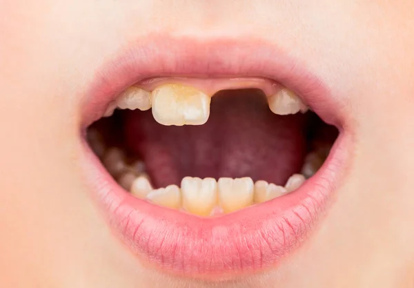 Bad teeth child. Portrait boy with bad teeth. Child smile and show her crowding tooth. Close up of unhealthy baby teeths. Kid patient open mouth showing cavities teeth decay — Stock Photo, Image