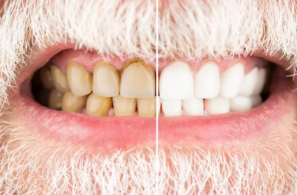 Hombre sonriente antes y después del procedimiento de blanqueamiento de dientes, primer plano. Primer plano de un hombre sonriente dientes antes y después del blanqueamiento. Dientes masculinos antes y después del blanqueamiento, odontología de cuidado oral, estomatología — Foto de Stock